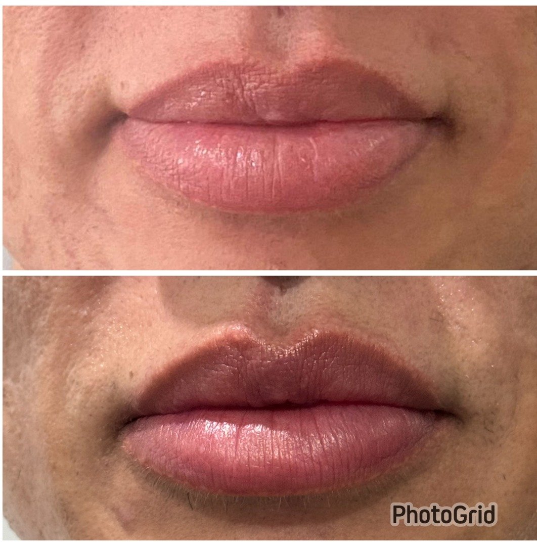 Caso Clínico Procedimento Labial com Laser de CO2